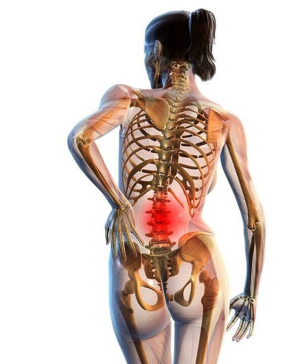 Osteochondrose der Lendenwirbelsäule tritt am häufigsten auf