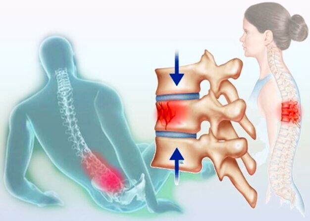 Schon eine gewöhnliche Verletzung kann die Entstehung einer Osteochondrose auslösen