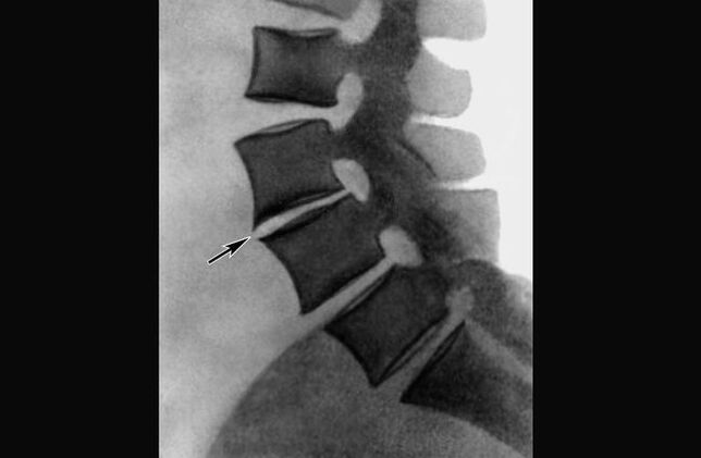 Manifestationen einer Osteochondrose der Brustwirbelsäule im Röntgenbild